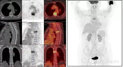 胸椎骨巨细胞瘤-PETCT检查案例