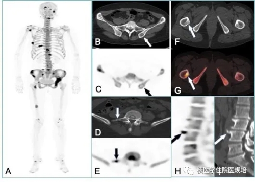 18F-NaF PET/CT乳腺癌骨转移-PETCT检查案例