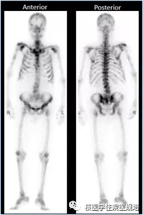 前列腺癌患者的印戒细胞癌多发骨转移-PETCT检查案例